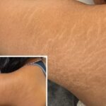 Stretch Mark Removal Myths vs Facts What You Really Need to Know