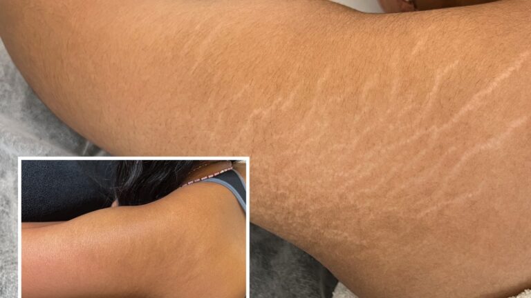 Stretch Mark Removal Myths vs Facts What You Really Need to Know