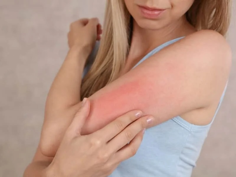 Scientific Insight into Eczedone An Innovative Approach to Gentle Eczema Relief